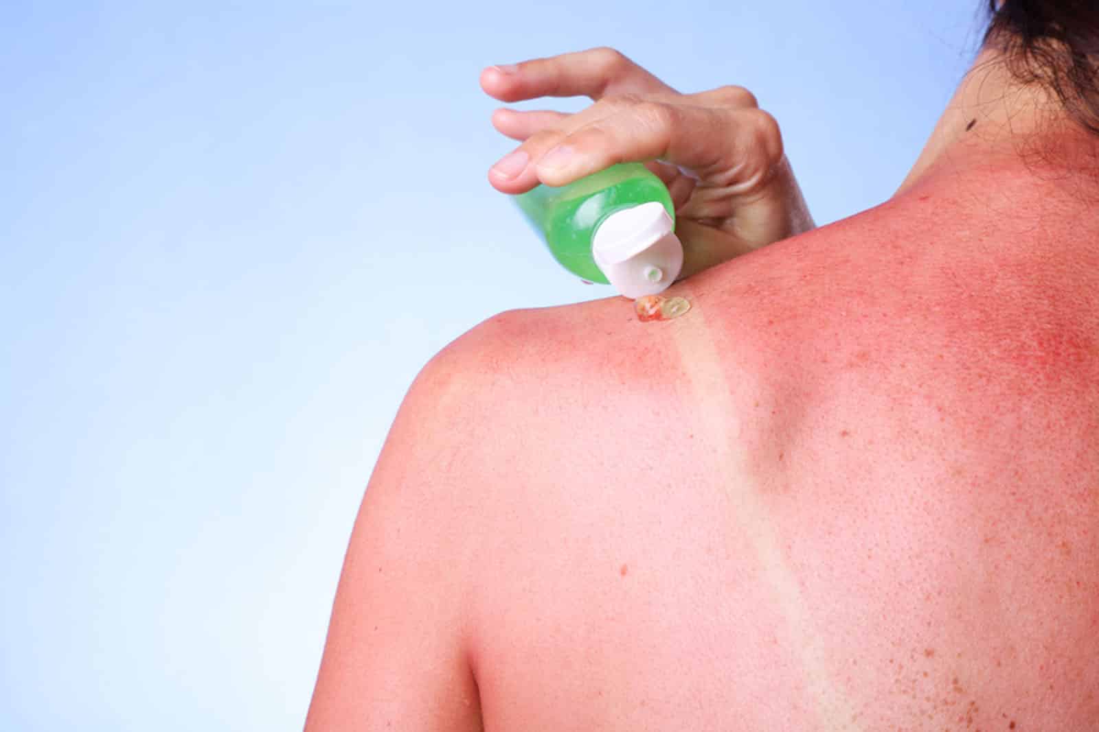 sunburn treatment